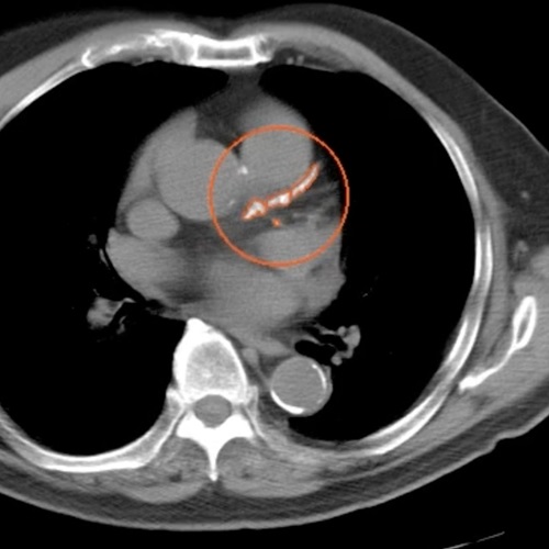 McLaren Health Care Launches First-of-its-Kind AI-Powered Cardiovascular Screening in Michigan